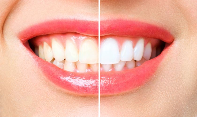 BLANQUEADOR DENTAL - TRANSFORMA TU SONRISA HOY MISMO EN 20 MINUTOS